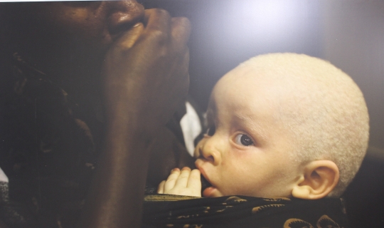 ‘Kara Kıtanın Beyaz Çocukları’: Afrikalı albinoların dramı sanatseverlerle buluştu